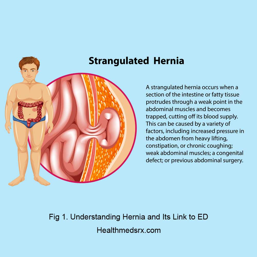 Impotence Hernia Effects Healthmedsrx.com