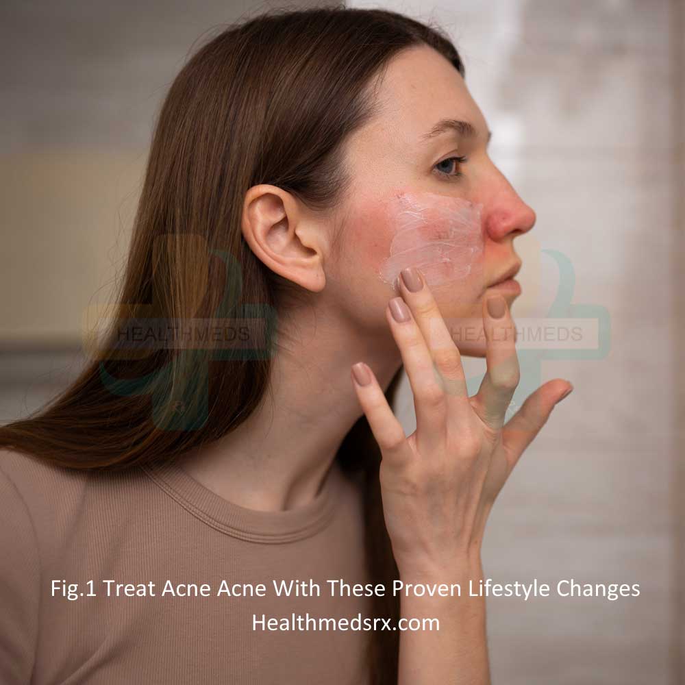 Acne With These Proven Lifestyle Changes