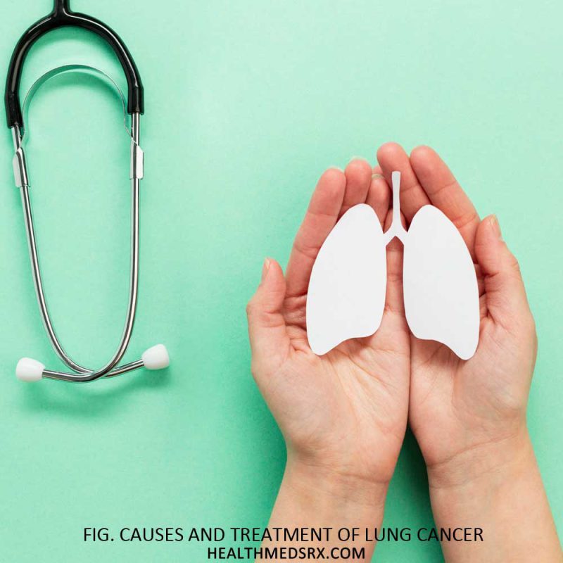Lung Cancer Causes and Treatments