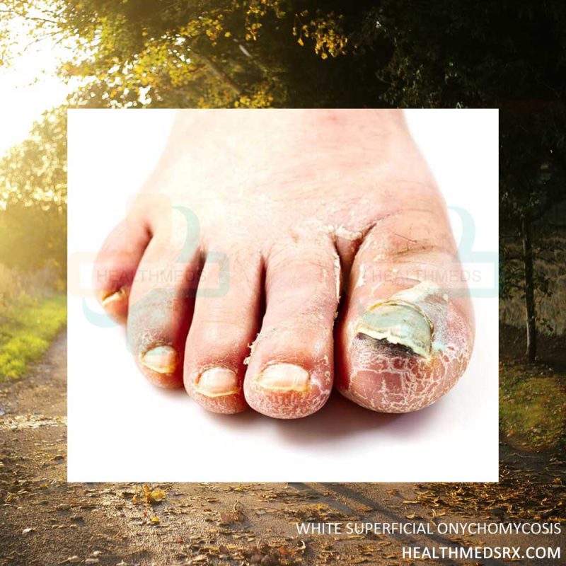 White Superficial Onychomycosis