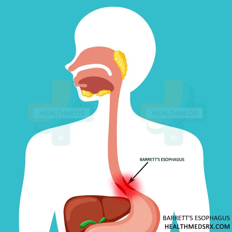 Barrett's Esophagus