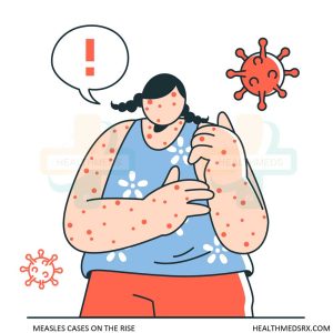 Measles Cases on the Rise