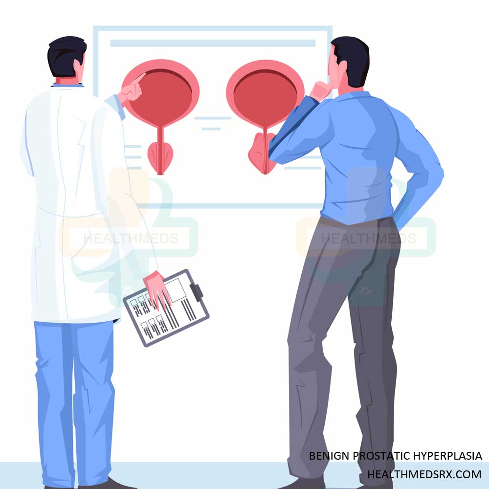 Benign Prostatic Hyperplasia