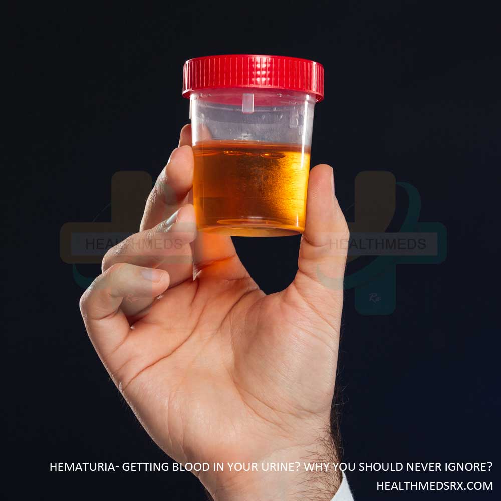 Hematuria Blood in the Urine