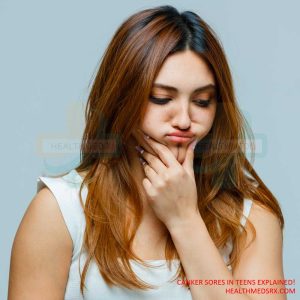Canker Sores in Teens Explained