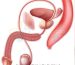 Penile Fracture