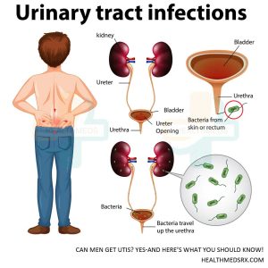 urinary tract infections (UTIs) in men